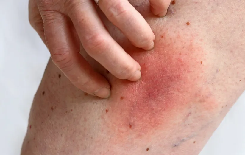 Risks of VenaSeal: Allergic Reactions